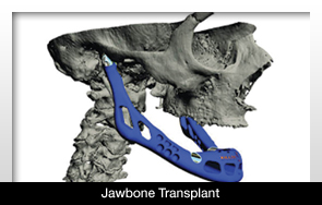 Woman Has Jawbone Transplant