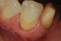 Class v cavity preparation for amalgam ppt presentation