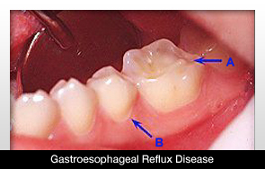 Tooth Surface Loss Rises for People with Gastroesophageal Reflux Disease