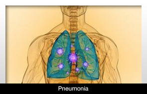 Poor Oral Health Could Lead to Pneumonia