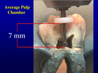 Pulp Chamber Morphology Basic Research Leads To Clinical Technique