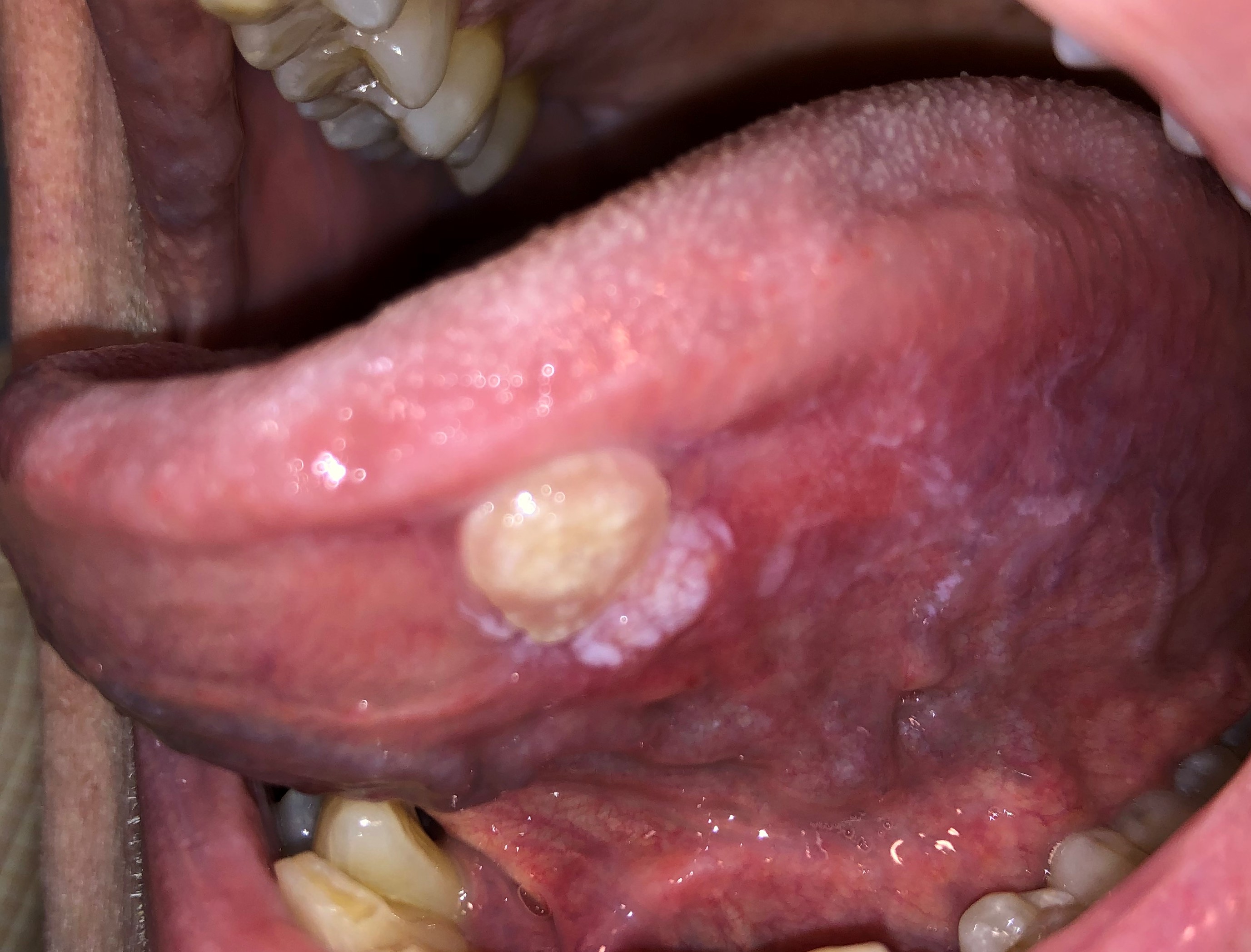 hpv throat dysplasia