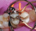 single visit endodontics