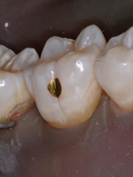 Gold Foil + Gold Inlays  Dental Gold Fillings and Inlays 