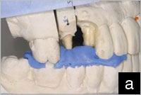 O-Bite Bite Registration. DMG - High quality dental materials for dentists  and dental technicians