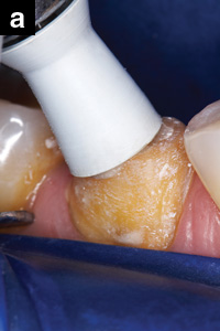 Immediate Dentin Sealing Technique - Dentistry Today