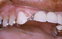 Dental Porcelain Repair - Porcelain Repair PFM Kit