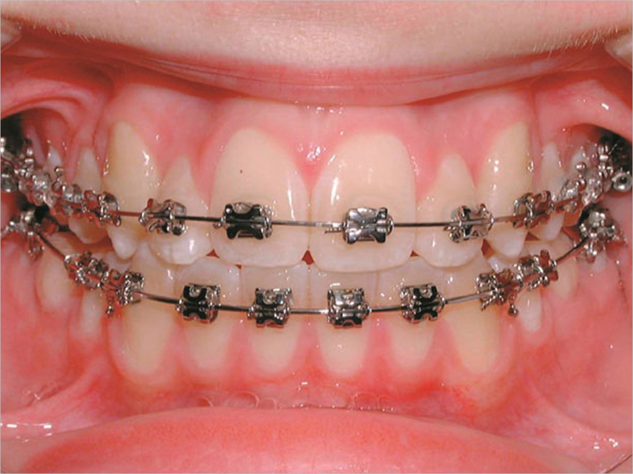 Obesity Influences Orthodontic Treatment in Adolescents