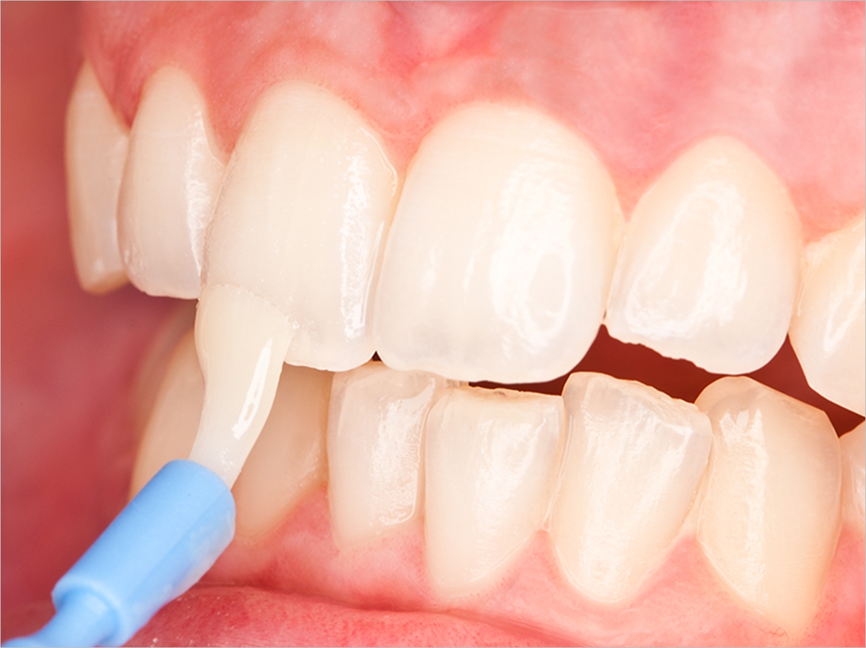 Покрытие фтором. Реминерализующая терапия глубокое фторирование. Глубокое фторирование эмали зуба. Глубокое фторирование эмали зуба (1 зуб). Реминерализирующая терапия эмали зубов.