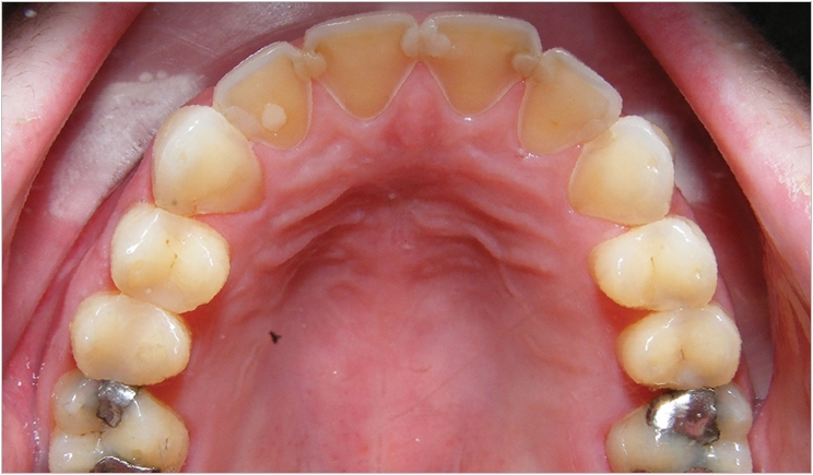 پوسیدگی دندانها از مهمترین عوارض بولیمیا می باشد 