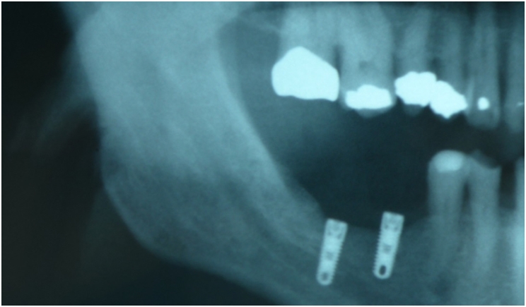 Mandibular nerve dental surgery