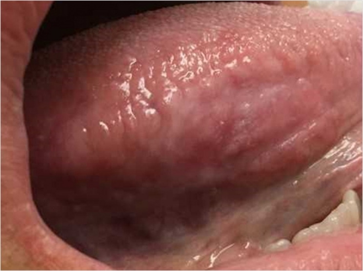 Human papillomavirus tongue cancer