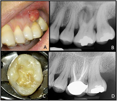 Cracked tooth syndromePart 2: restorative options for the management of cracked  tooth syndrome - British Dental Journal