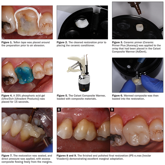 Ceramic Repair Intro Pack - Dental Needs