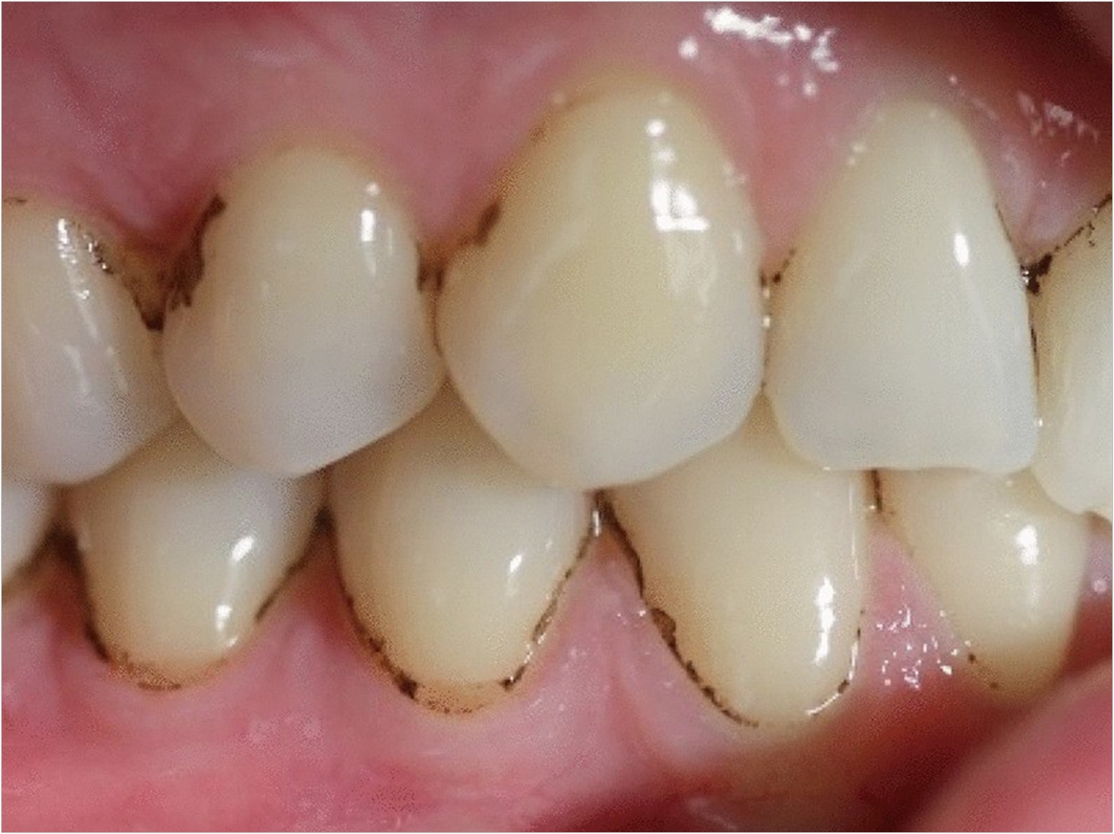 Researchers Map The Metagenomics Of Dental Black Plaque Dentistry Today
