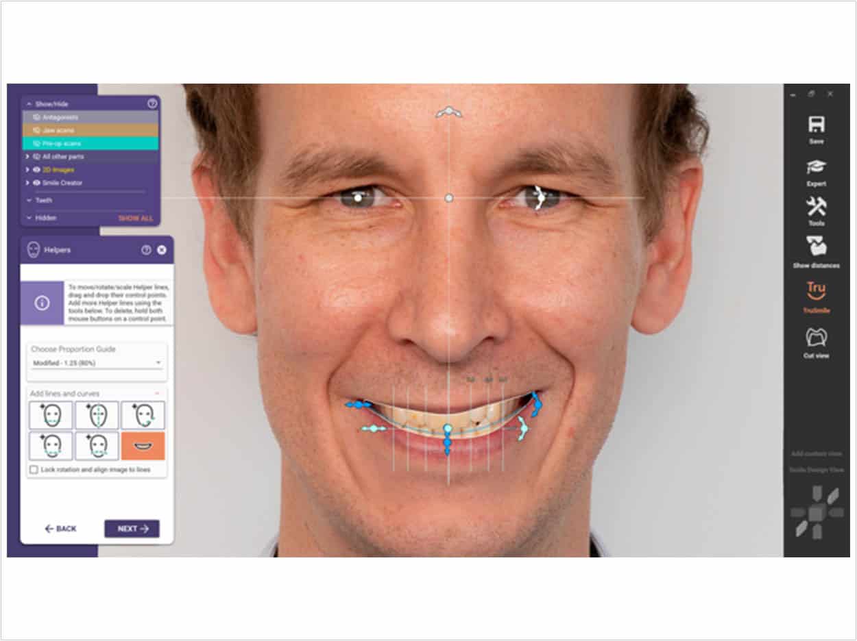 Software Update Reduces Orthodontic Design Time - Dentistry Today