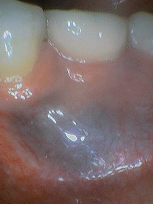 Macular Pigmented Oral Mucosal Lesions: An Amalgam Tattoo Case Report -  Dentistry Today