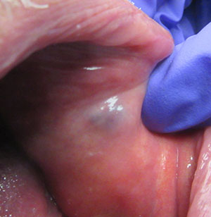 Removal of an amalgam tattoo using a subepithelial connective tissue graft  and laser deepithelialization  Semantic Scholar