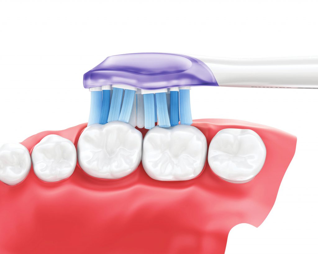 periodontal, phillips