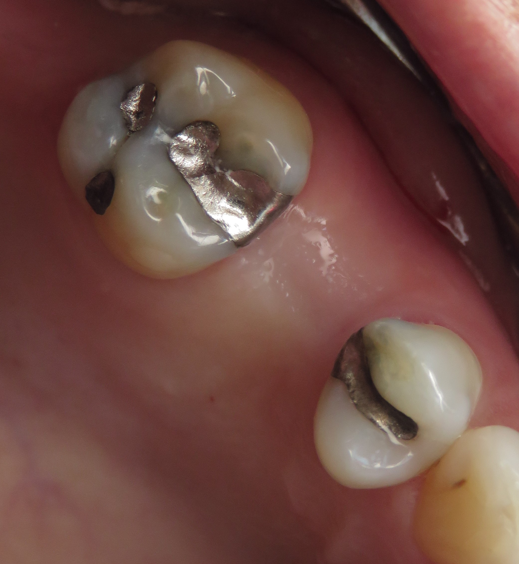 ceramic dental implants