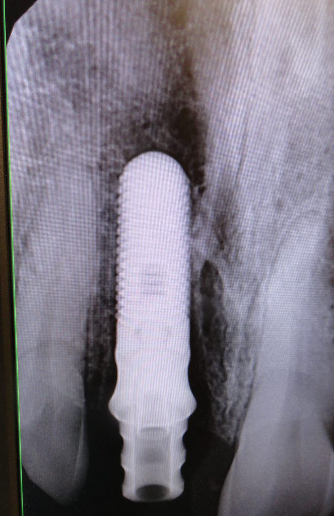 immediate implant placement