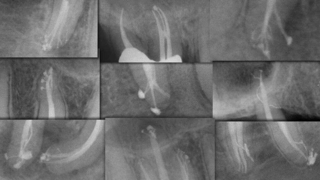 endodontic disinfection