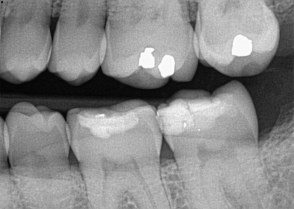 occlusal caries