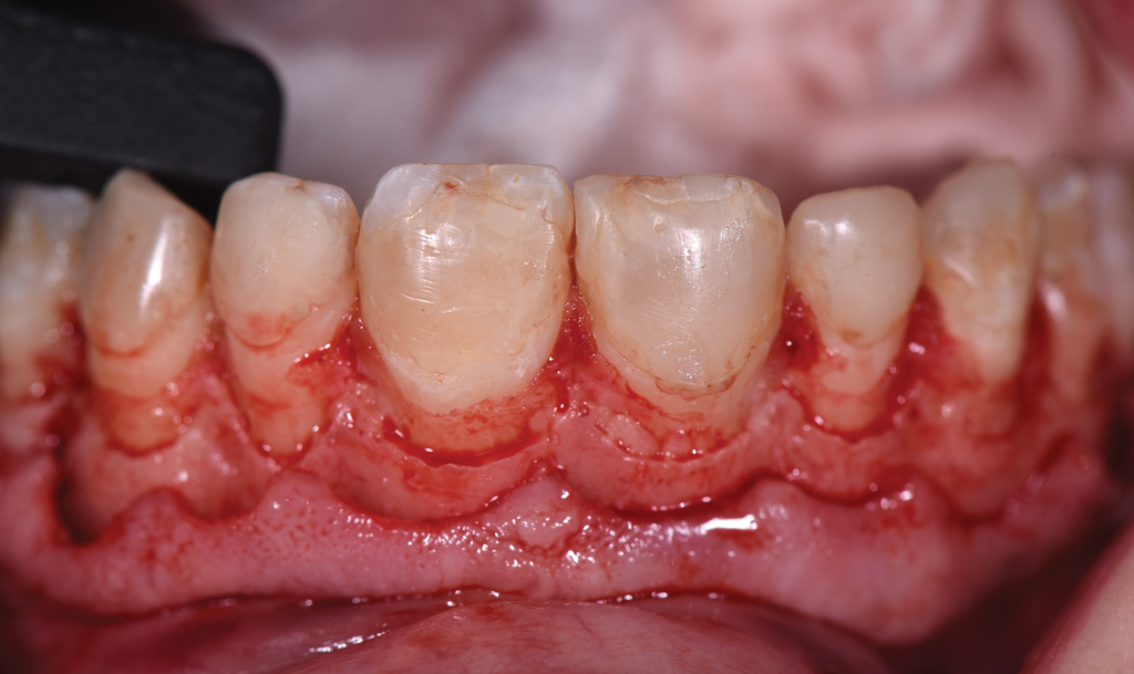 aesthetic crown lengthening