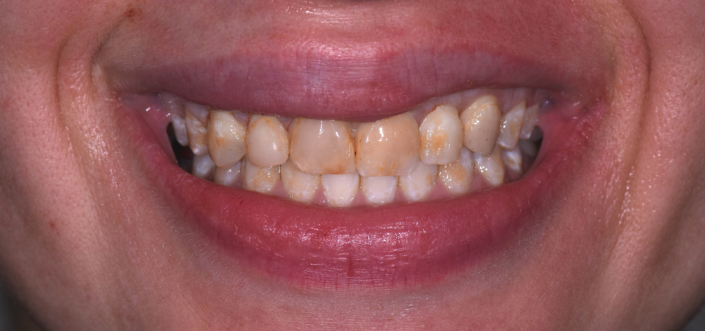 aesthetic crown lengthening