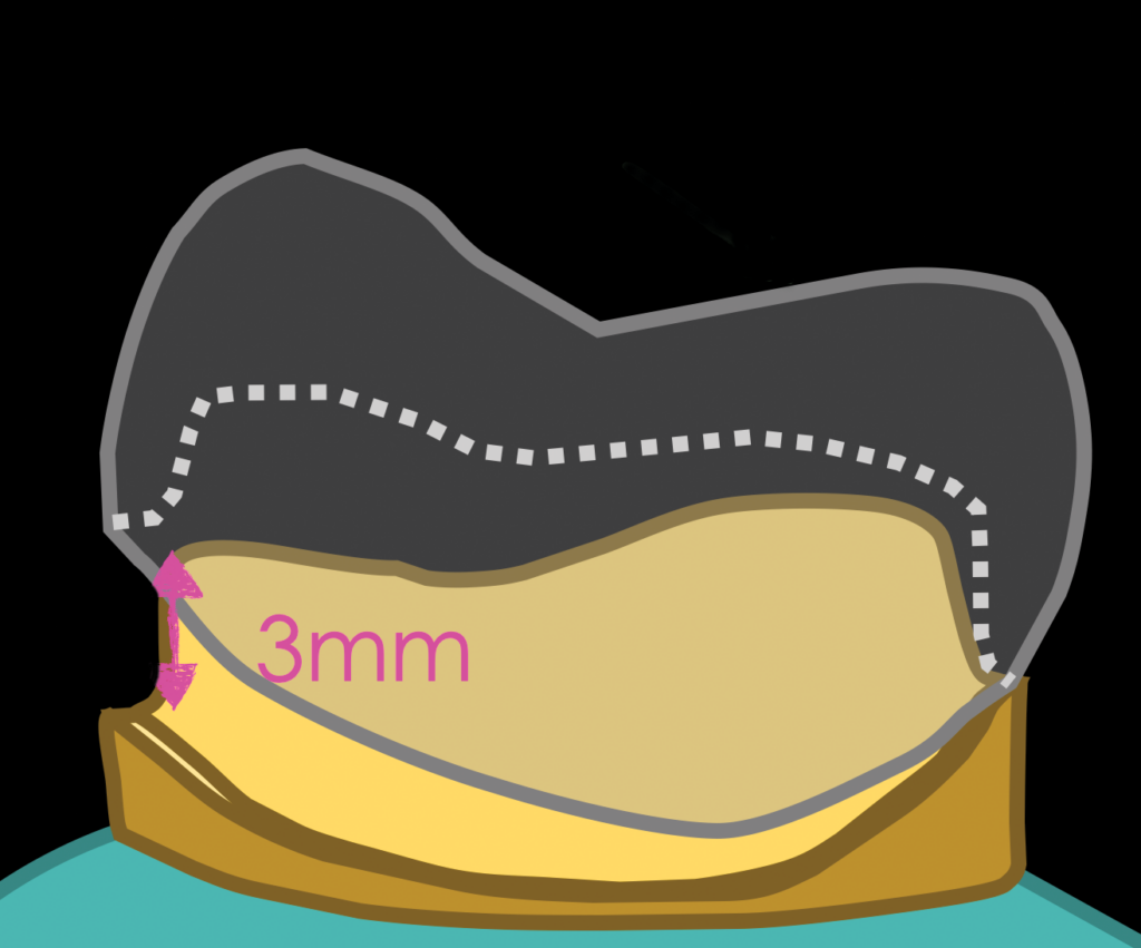ceramic restorations