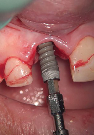immediate implant placement