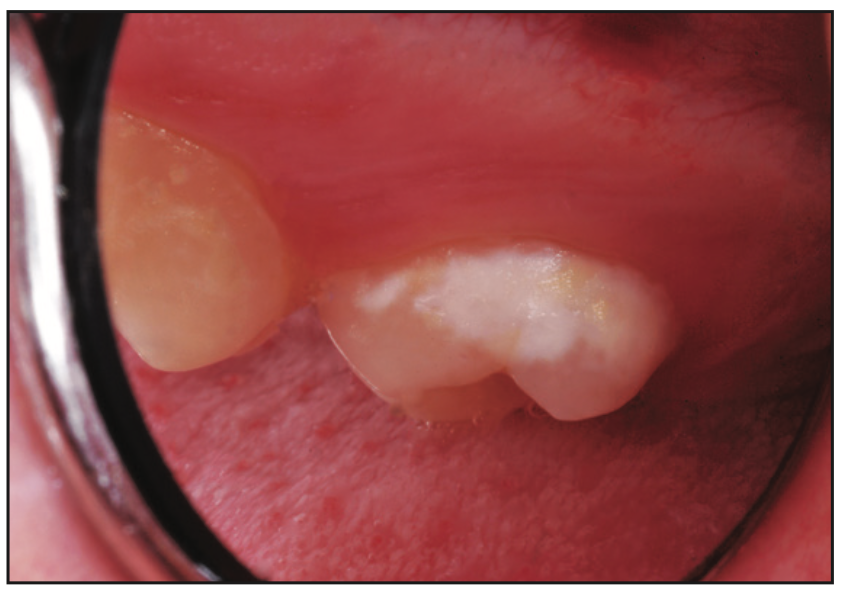 smooth-surface dental caries