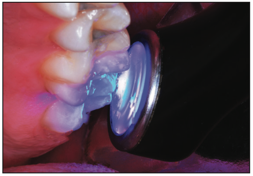 smooth-surface dental caries