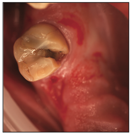 temporary gingival retraction 