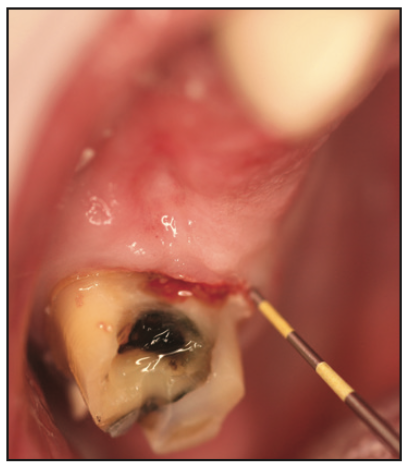 temporary gingival retraction