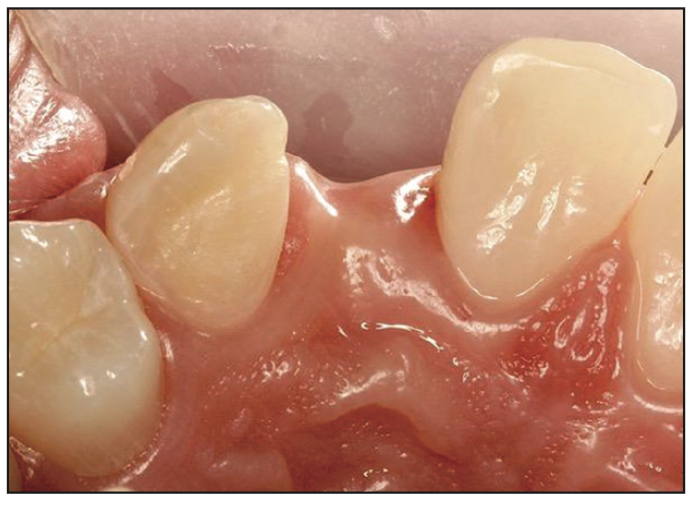 Resin Bonded Bridge: Minimally Invasive Option for Tooth Replacement - Shor  Dental