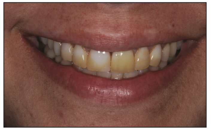 Predictable Strategy to Oblique Blended-Media Beauty Dentistry