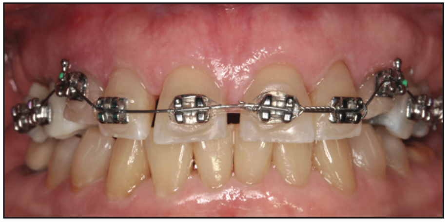 Long-term, Provisional, 3D Printed Restorations as Part of a Complex Treatment Plan