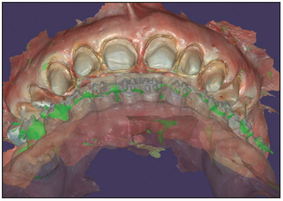 Long-term, Provisional, 3D Printed Restorations as Part of a Complex Treatment Plan