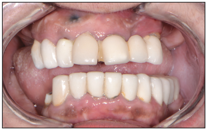 Full-Mouth Reconstruction Workflow in a Hopeless Situation
