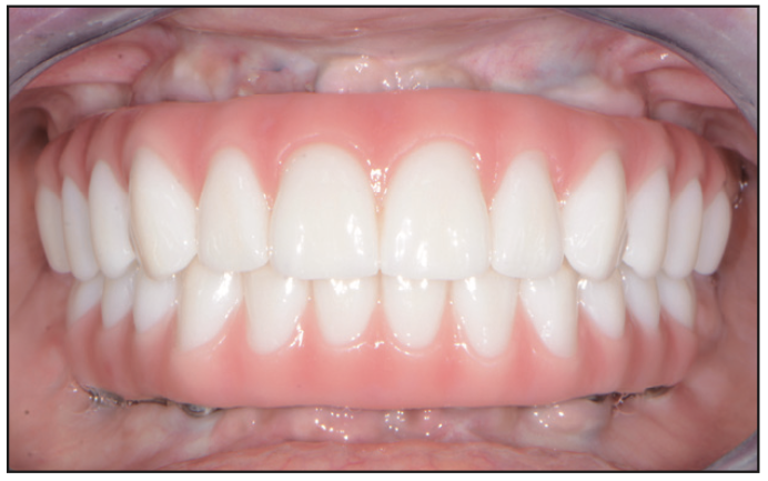 Full-Mouth Reconstruction Workflow in a Hopeless Situation