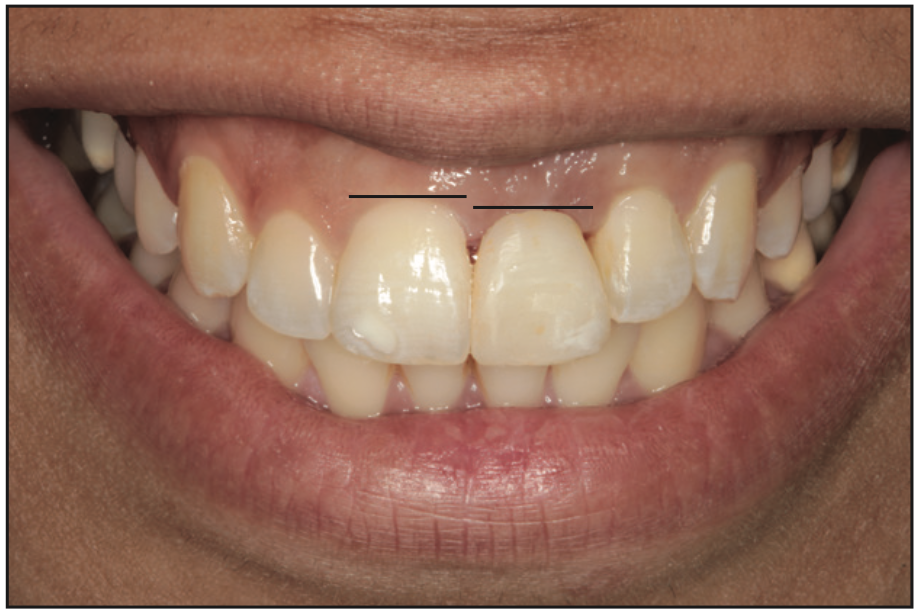 maxillary central incisor implant