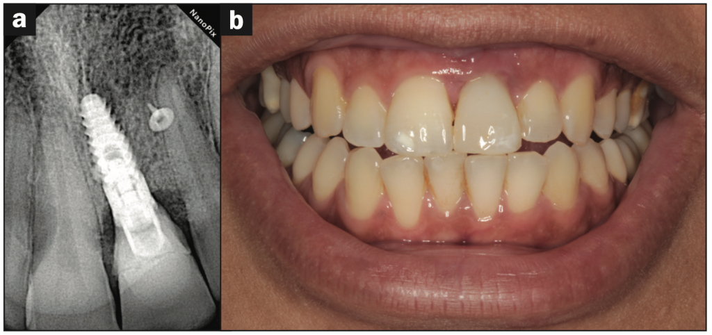 maxillary central incisor implant