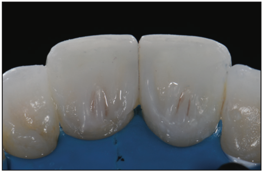 Direct Biomimetic Endodontic Access restorations