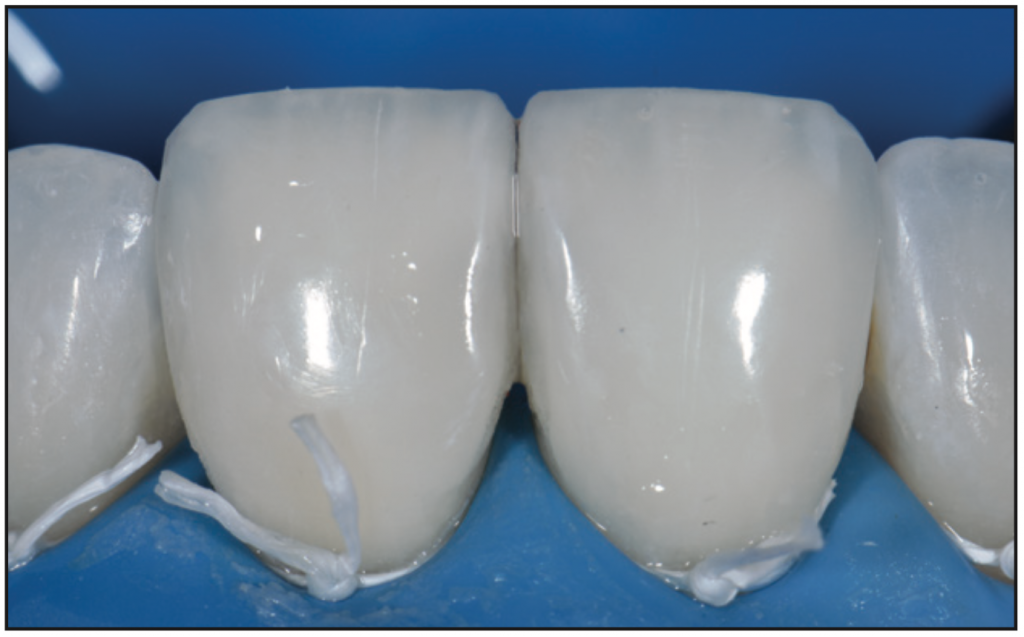Direct Biomimetic Endodontic Access restorations
