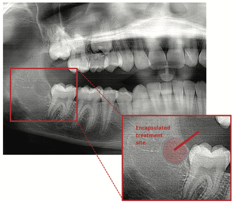 third molar