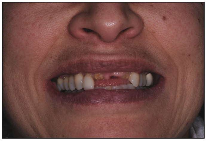 complex dental restoration,