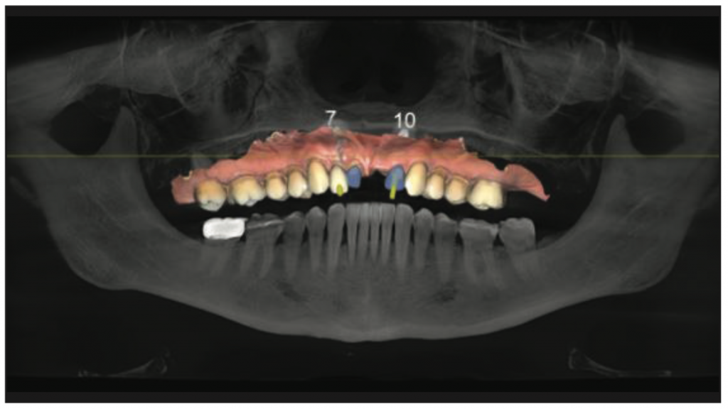 complex dental restoration