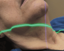 laser therapy, dentistry