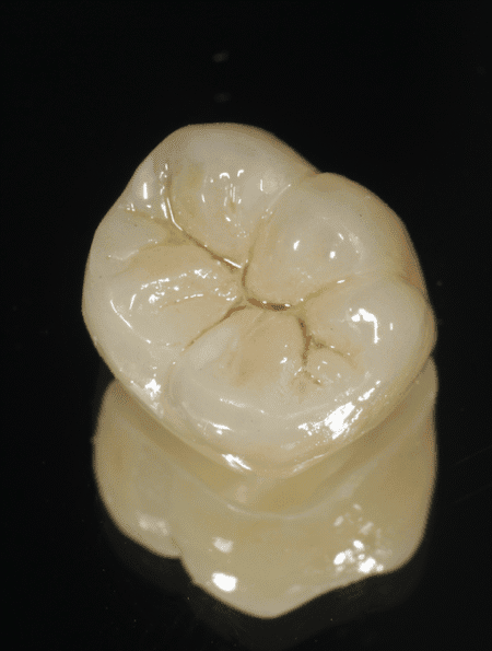assured dental lab, Z-Brux™ Direct